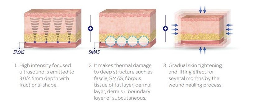 https://cleopatra-aesthetics-center.com/wp-content/uploads/2018/12/How-does-HIFU-works-1.jpg